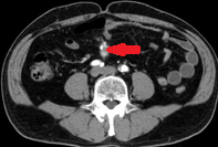 Whole-body scintigraphy (Octreoscan). The pathological focus at the root of the mesentery is clearly visible (Courtesy Dr. V. Penopoulos)