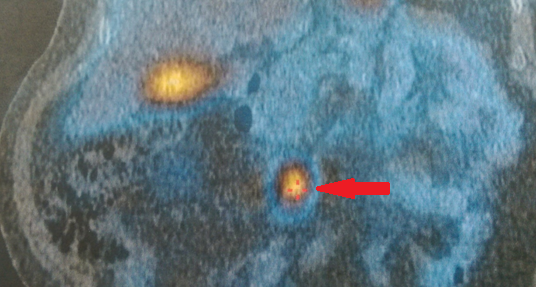 The whole-body scintigraphy (Octreoscan) also revealed another focus in the thyroid gland, which was due to a known benign nodule of the organ (Courtesy Dr. V. Penopoulos)