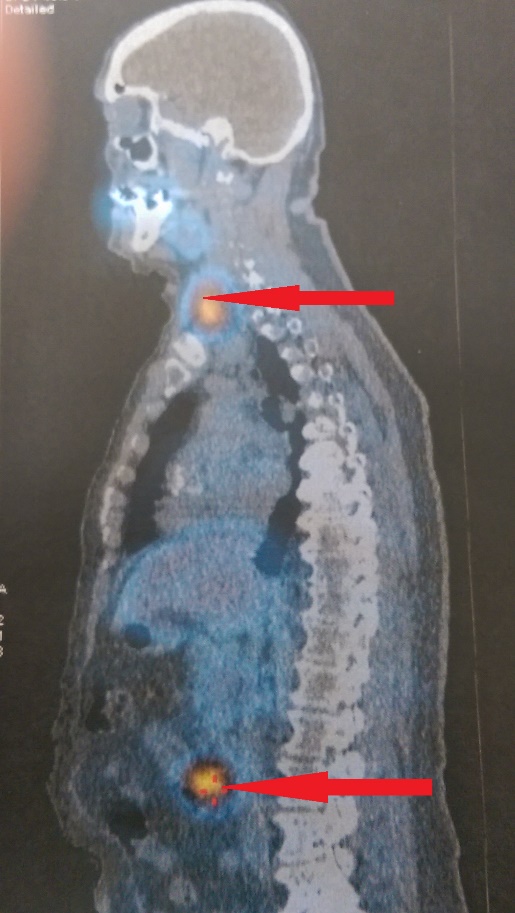 The whole-body scintigraphy (Octreoscan) also revealed another focus in the thyroid gland, which was due to a known benign nodule of the organ (Courtesy Dr. V. Penopoulos)