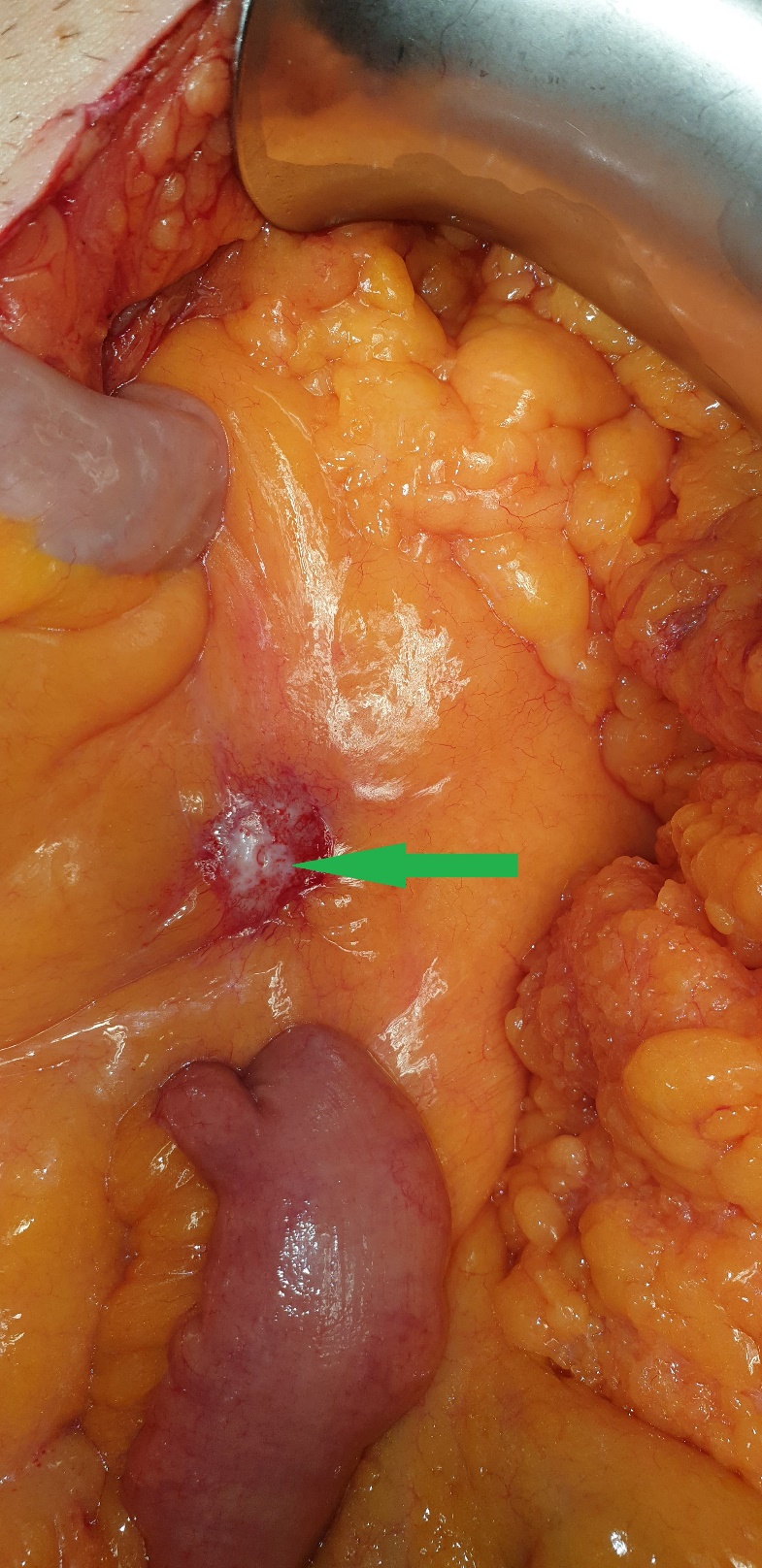 Completely excised metastatic lymph node mass (Courtesy Dr. V. Penopoulos)