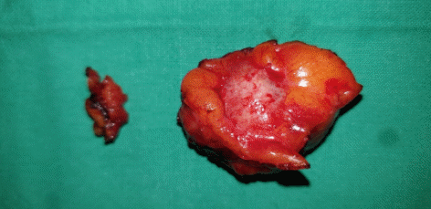 Completely excised metastatic lymph node mass (Courtesy Dr. V. Penopoulos)