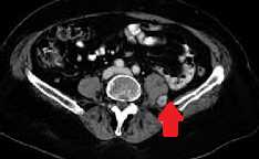 MRI of the retroperitoneum. Red arrow — metastatic lesion in the left psoas muscle (Courtesy Dr. V. Penopoulos).