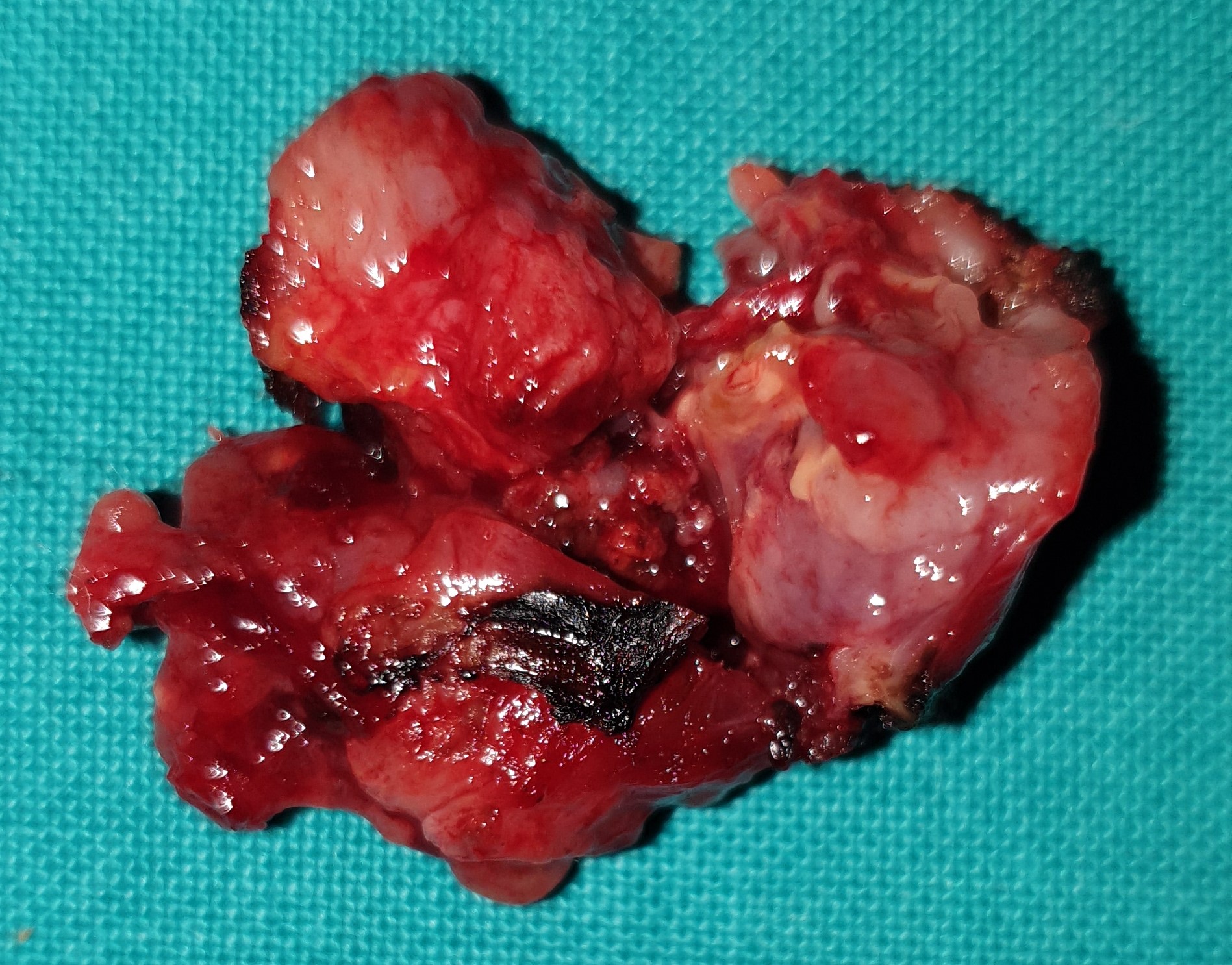 Surgical specimen of the metastatic lesions of the left psoas muscle (Courtesy Dr. V. Penopoulos).
