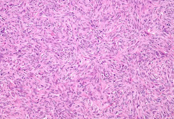 Solitary fibrous tumor of the liver (Courtesy Dr. V. Penopoulos)
