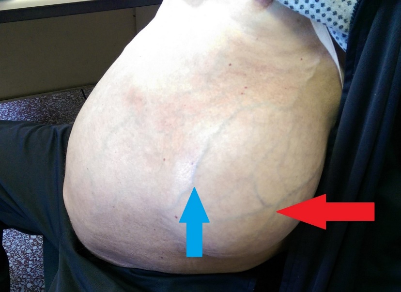 Μπλε βέλος. Το κηλικό στόμιο διά του οποίου εισέρχεται το ασκιτικό υγρό στη μεσοπλεύρια κήλη (Ευγενική παραχώρηση Dr. V. Penopoulos)