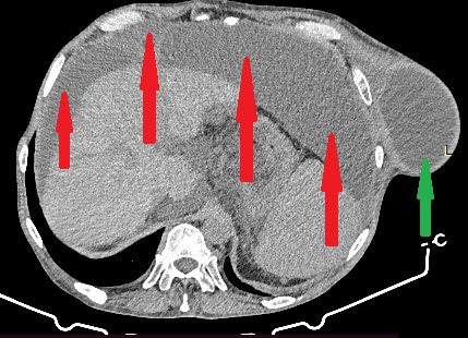 Μπλε βέλος. Το κηλικό στόμιο διά του οποίου εισέρχεται το ασκιτικό υγρό στη μεσοπλεύρια κήλη (Ευγενική παραχώρηση Dr. V. Penopoulos)