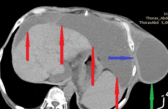 Μπλε βέλος. Το κηλικό στόμιο διά του οποίου εισέρχεται το ασκιτικό υγρό στη μεσοπλεύρια κήλη (Ευγενική παραχώρηση Dr. V. Penopoulos)