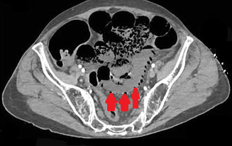 Παρουσία αέρα στο πυλαίο φλεβικό σύστημα, δευτεροπαθώς σε ισχαιμική κολίτιδα (Ευγενική παραχώρηση Dr. V. Penopoulos)