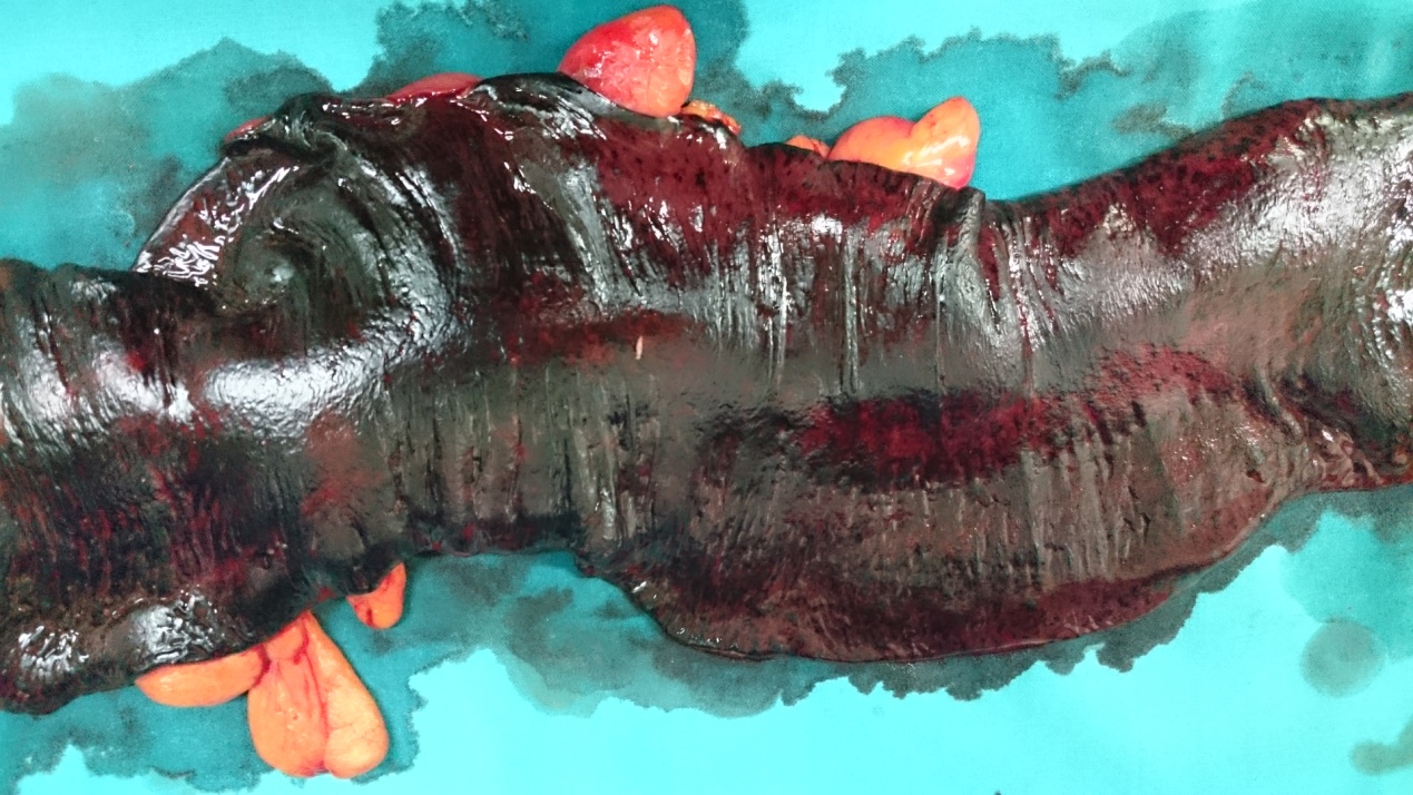 Πράσινο βέλος – εστιακή εξέλκωση κολικού βλεννογόνου. Κίτρινο βέλος – οίδημα και λεμφοκυτταρική διήθηση υποβλεννογόνιου χιτώνα (Ευγενική παραχώρηση Dr. V. Penopoulos)