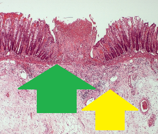 Πράσινο βέλος – περιφλεβιδική λεμφοκυτταρική διήθηση σε υποβλεννογόνια θέση (Ευγενική παραχώρηση Dr. V. Penopoulos)