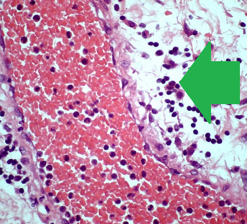 Πράσινο βέλος – περιφλεβιδική λεμφοκυτταρική διήθηση σε υποβλεννογόνια θέση (Ευγενική παραχώρηση Dr. V. Penopoulos)