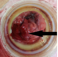 Metastasis in the ileostomy loop (Courtesy Dr. V. Penopoulos).