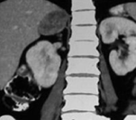 CT scan, 13 years after the initial identification of a non-functional incidentaloma of the right adrenal gland. Presence of a heterogeneous tumor – adrenocortical carcinoma of the right adrenal gland (Courtesy Dr. V. Penopoulos)