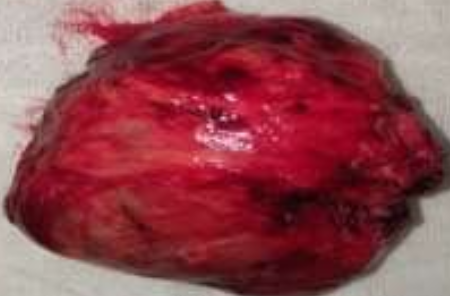 Surgical specimen, right adrenalectomy (Courtesy Dr. V. Penopoulos)