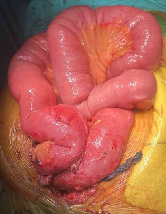 Completely healed wound of the right hemiscrotum (Courtesy Dr. V. Penopoulos)