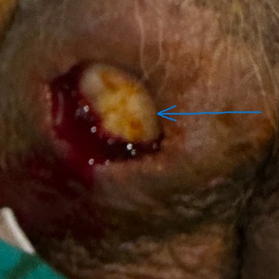 Completely healed wound of the right hemiscrotum (Courtesy Dr. V. Penopoulos)