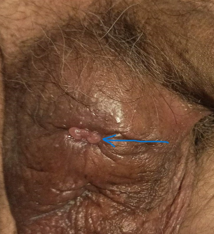 Completely healed wound of the right hemiscrotum (Courtesy Dr. V. Penopoulos)
