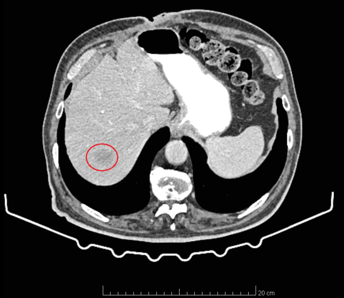 CT of the upper abdomen. Solitary metastatic focus in segment VII of the liver (Courtesy Dr. V. Penopoulos)