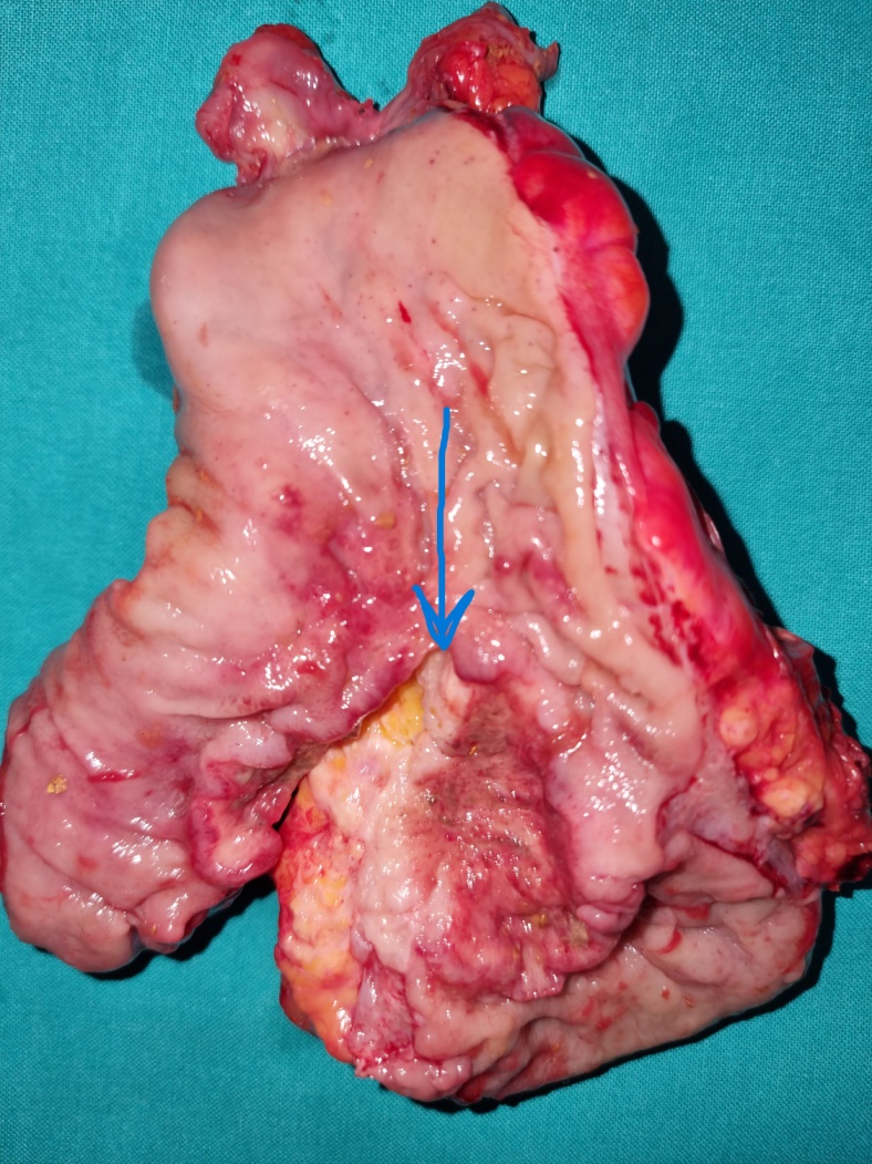 Low anterior resection of the rectum – Total mesorectal excision (Courtesy Dr. V. Penopoulos)