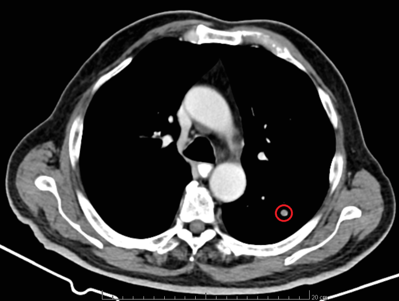 Extensive adhesiolysis. Released small bowel loops (Courtesy Dr. V. Penopoulos)