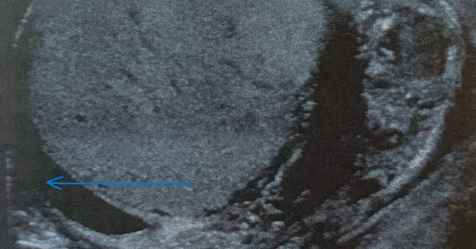 Spontaneously drained "malignant" right hydrocele (Courtesy Dr. V. Penopoulos)