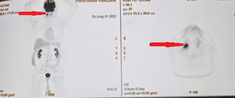 PET scan ολόκληρου σώματος. Παθολογική πρόσληψη στη δεξιά υπερώια αμυγδαλή (Ευγενική παραχώρηση Dr. V. Penopoulos)