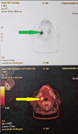 PET scan ολόκληρου σώματος. Παθολογική πρόσληψη στη δεξιά υπερώια αμυγδαλή (Ευγενική παραχώρηση Dr. V. Penopoulos)