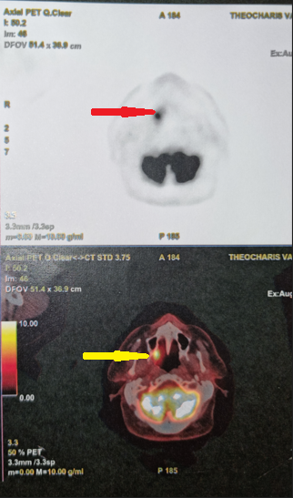 PET scan ολόκληρου σώματος. Παθολογική πρόσληψη στη δεξιά υπερώια αμυγδαλή (Ευγενική παραχώρηση Dr. V. Penopoulos)
