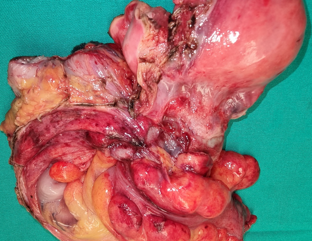 D2-40 stain. The lining cells of the cyst wall were positive for calretinin and negative for D2-40 (Courtesy Dr. V. Penopoulos)