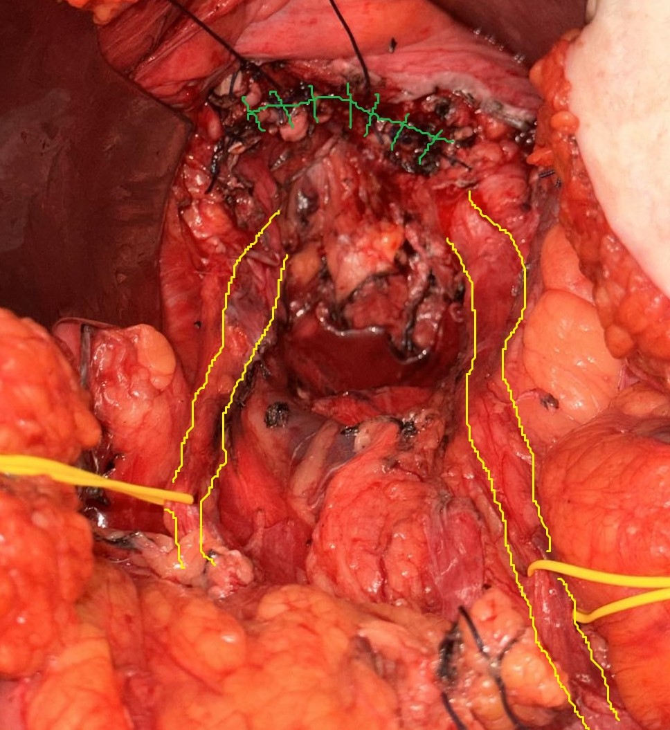 Yellow outline: released right ureter. Green outline: sutured vaginal stump (Courtesy Dr. V. Penopoulos)