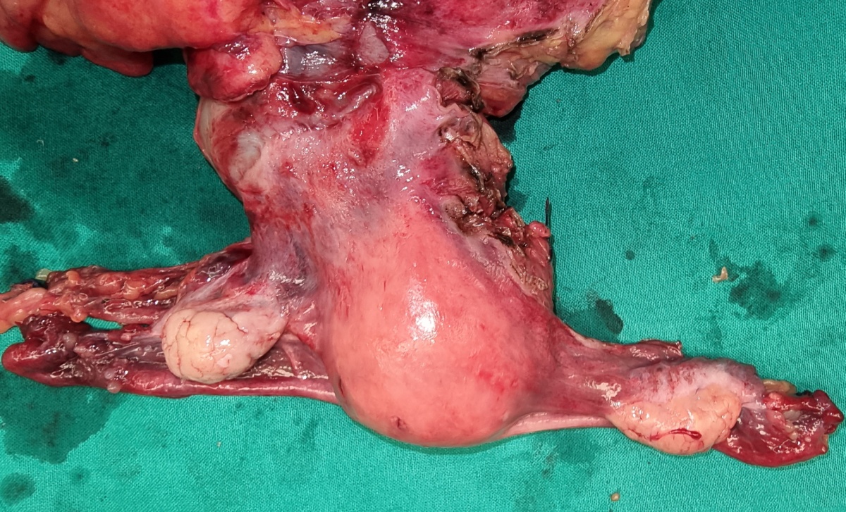 Mesothelial cyst. Hematoxylin and eosin stain (Courtesy Dr. V. Penopoulos)