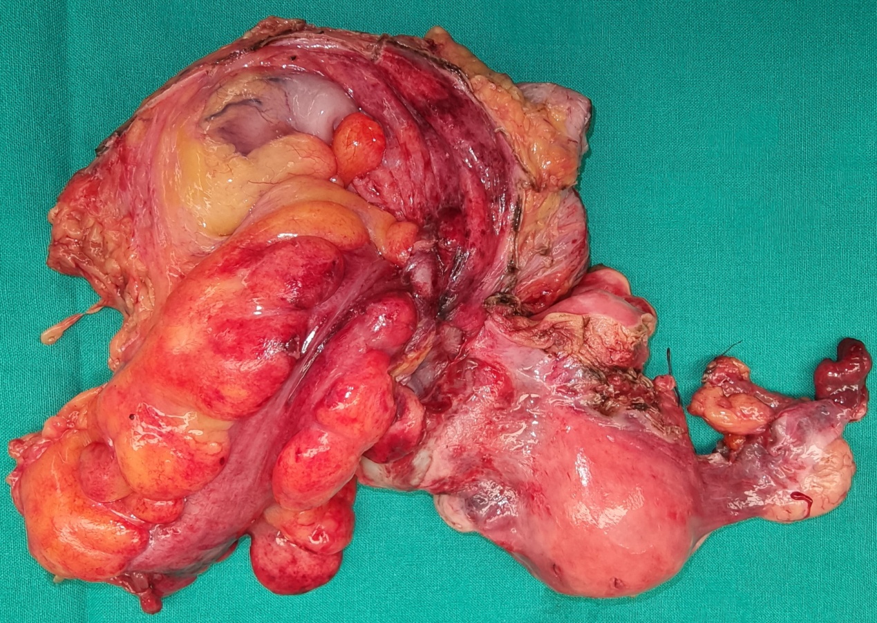 Calretinin stain (Courtesy Dr. V. Penopoulos)