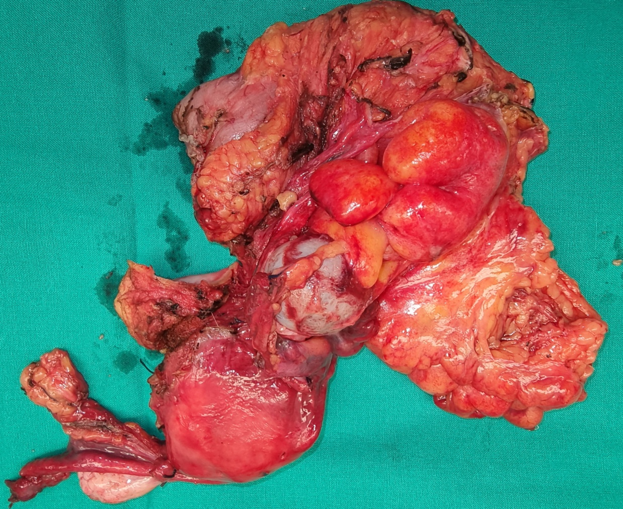 D2-40 stain. The lining cells of the cyst wall were positive for calretinin and negative for D2-40 (Courtesy Dr. V. Penopoulos)