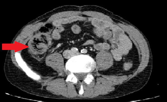 Κόκκινο βέλος: νέκρωση τυφλού (Ευγενική παραχώρηση Dr. V. Penopoulos)