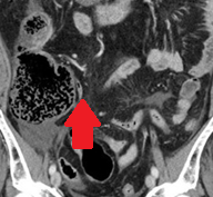 Κόκκινο βέλος: παρουσία ελεύθερου αέρα (Ευγενική παραχώρηση Dr. V. Penopoulos)