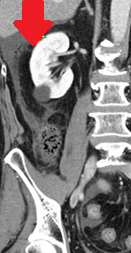 Πράσινο βέλος: νέκρωση τυφλού. Μπλε βέλος: φυσιολογική σκωληκοειδής απόφυση (Ευγενική παραχώρηση Dr. V. Penopoulos)