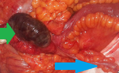 Πράσινο βέλος: νέκρωση τυφλού. Μπλε βέλος: φυσιολογική σκωληκοειδής απόφυση (Ευγενική παραχώρηση Dr. V. Penopoulos)