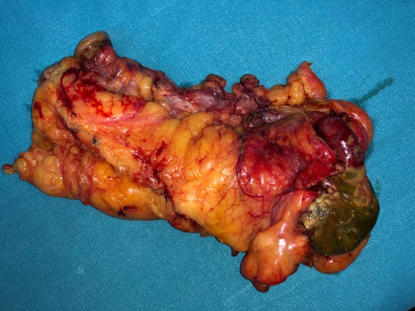 Χειρουργικό παρασκεύασμα. Εμφανής η νέκρωση τμήματος του τυφλού (Ευγενική παραχώρηση Dr. V. Penopoulos)