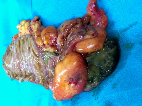 Χειρουργικό παρασκεύασμα. Εμφανής η νέκρωση τμήματος του τυφλού (Ευγενική παραχώρηση Dr. V. Penopoulos)