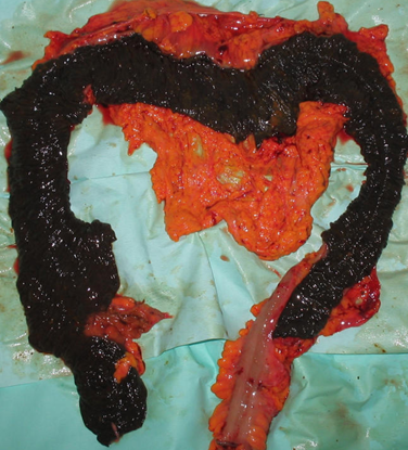 Παρασκεύασμα υποολικής κολεκτομής (Ευγενική παραχώρηση Dr. V. Penopoulos)