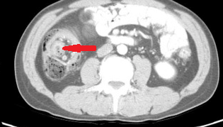 CT κοιλίας. Κόκκινο βέλος: λίπωμα ειλεοτυφλικής βαλβίδας (Ευγενική παραχώρηση Dr. V. Penopoulos)