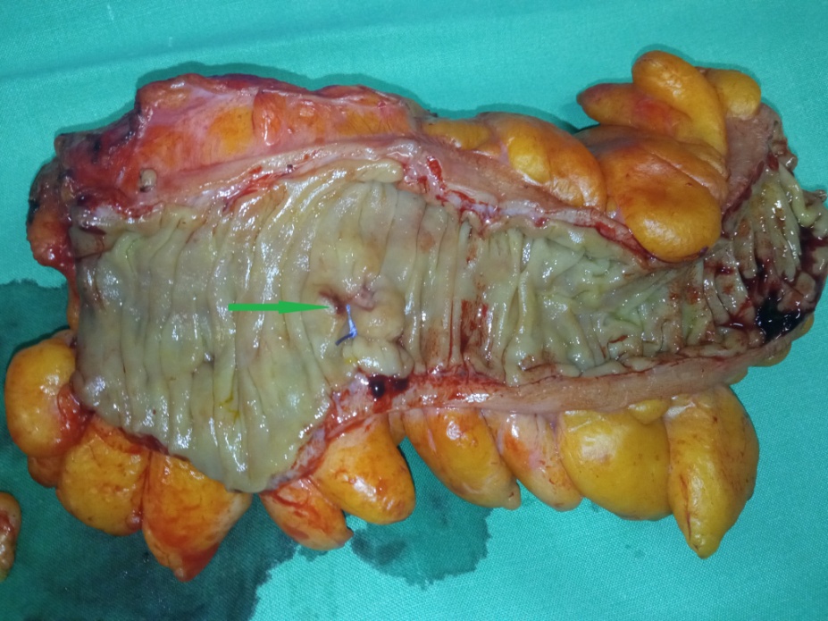Παρασκεύασμα σιγμοειδούς. Πράσινο βέλος: σωληνολαχνωτό αδένωμα που έχει μετατραπεί σε αδενοκαρκίνωμα (Ευγενική παραχώρηση Dr. V. Penopoulos)