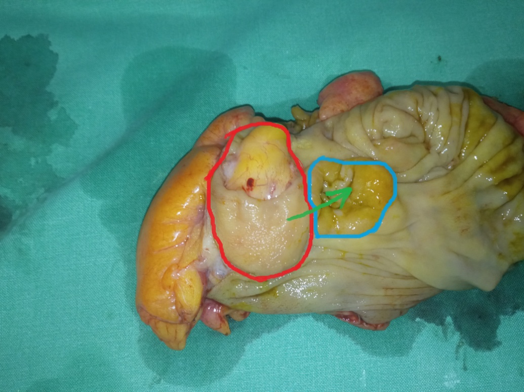 Παρασκεύασμα μίνι δεξιάς ημικολεκτομής. Κόκκινο περίγραμμα: λίπωμα. Μπλε περίγραμμα: ειλεοτυφλική βαλβίδα. Πράσινο βέλος: απεικονίζει την πορεία του λιπώματος, με αποτέλεσμα πλήρη απόφραξη της ειλεοτυφλικής βαλβίδας (Ευγενική παραχώρηση Dr. V. Penopoulos)