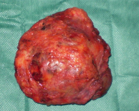 Εκτεθέν λειομυοσάρκωμα αριστερής περιοχής ώμου (Ευγενική παραχώρηση Dr. V. Penopoulos)