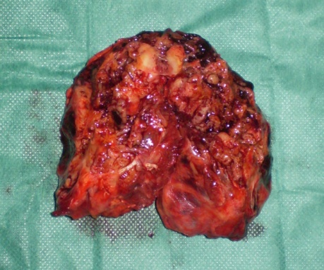 Ανοσοϊστοχημική χρώση, έντονα θετική για λεία μυοσίνη-ακτίνη (Ευγενική παραχώρηση Dr. V. Penopoulos)