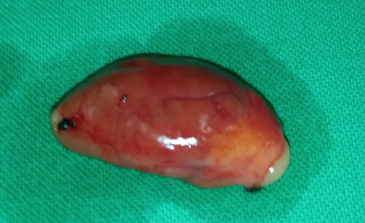 Cystic parathyroid adenoma (Courtesy Dr. V. Penopoulos)