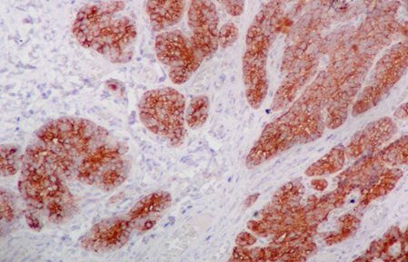 Immunohistochemical evaluation demonstrated positivity for parathyroid hormone and chromogranin, with low mitotic and proliferative activity (Courtesy Dr. V. Penopoulos)