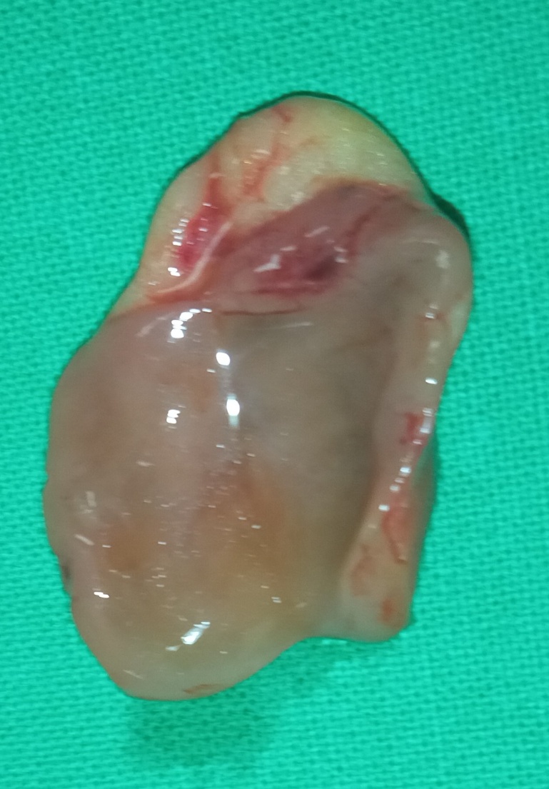Immunohistochemical evaluation demonstrated positivity for parathyroid hormone and chromogranin, with low mitotic and proliferative activity (Courtesy Dr. V. Penopoulos)
