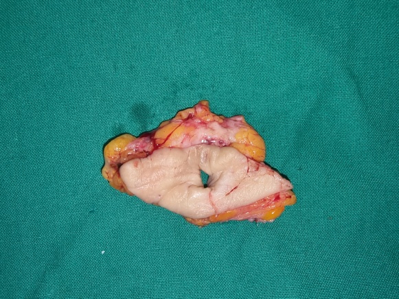 Αιμορραγούντες ανορθικοί κιρσοί (πράσινα βέλη). Έντονη διάταση εξωτερικού αιμορροϊδικού φλεβικού πλέγματος, επικοινωνούντος με τους ορθικούς κιρσούς (μπλε βέλη) (Ευγενική παραχώρηση Dr. V. Penopoulos)