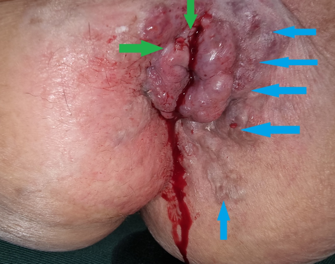 Αιμορραγούντες ανορθικοί κιρσοί (πράσινα βέλη). Έντονη διάταση εξωτερικού αιμορροϊδικού φλεβικού πλέγματος, επικοινωνούντος με τους ορθικούς κιρσούς (μπλε βέλη) (Ευγενική παραχώρηση Dr. V. Penopoulos)